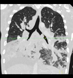 Lymphoma With Tumor in Airway and Lung Parenchyma in Addition to Adenopathy - CTisus CT Scan