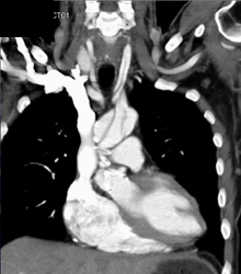 Dissection Extends Into Left Carotid Artery - CTisus CT Scan