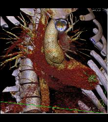 Dilated Aortic Root - CTisus CT Scan