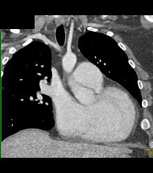 Pulmonary Artery Aneurysm - CTisus CT Scan