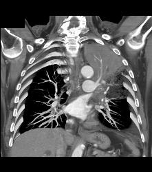 Lung Cancer Encases the Left Main Pulmonary Artery - CTisus CT Scan