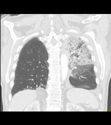 Lung Cancer Encases the Left Main Pulmonary Artery - CTisus CT Scan