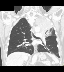 Lung Cancer Encases the Left Main Pulmonary Artery - CTisus CT Scan