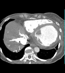 Poor Cardiac Function and Reflux of Contrast Into IVC - CTisus CT Scan