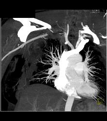 Right Subclavian and Axillary Artery Clot in Patient With Subclavian Steal Symptoms- Multiple Sequences - CTisus CT Scan