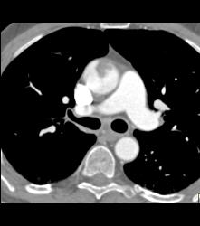 Clot in Aorta - CTisus CT Scan