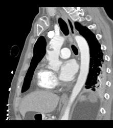 Clot in Aorta - CTisus CT Scan