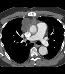 Lymphoma - CTisus CT Scan