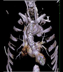 Marfan With Dural Ectasia and Complex Aortic Dissection Repair With Elephant Trunk and Reimplantation of Coronary Arteries- See Full Sequence - CTisus CT Scan