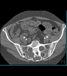 Marfan With Dural Ectasia and Complex Aortic Dissection Repair With Elephant Trunk and Reimplantation of Coronary Arteries- See Full Sequence - CTisus CT Scan