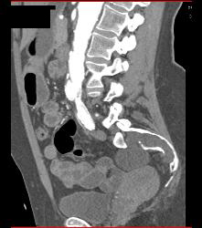 Marfan With Dural Ectasia and Complex Aortic Dissection Repair With Elephant Trunk and Reimplantation of Coronary Arteries- See Full Sequence - CTisus CT Scan