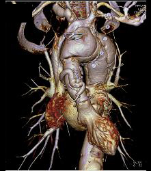 Marfan With Dural Ectasia and Complex Aortic Dissection Repair With Elephant Trunk and Reimplantation of Coronary Arteries- See Full Sequence - CTisus CT Scan