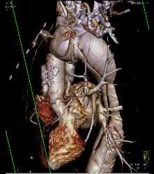 Marfan With Dural Ectasia and Complex Aortic Dissection Repair With Elephant Trunk and Reimplantation of Coronary Arteries- See Full Sequence - CTisus CT Scan