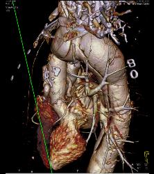Marfan With Dural Ectasia and Complex Aortic Dissection Repair With Elephant Trunk and Reimplantation of Coronary Arteries- See Full Sequence - CTisus CT Scan