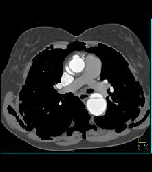 Marfan With Dural Ectasia and Complex Aortic Dissection Repair With Elephant Trunk and Reimplantation of Coronary Arteries- See Full Sequence - CTisus CT Scan