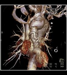 Marfan With Dural Ectasia and Complex Aortic Dissection Repair With Elephant Trunk and Reimplantation of Coronary Arteries- See Full Sequence - CTisus CT Scan