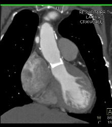 Marfan With Dural Ectasia and Complex Aortic Dissection Repair With Elephant Trunk and Reimplantation of Coronary Arteries- See Full Sequence - CTisus CT Scan