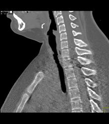 Tracheal Stenosis Due to Prior Intubation - CTisus CT Scan