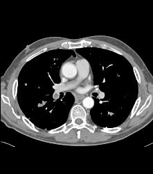 Pulmonary Embolism (PE) and Lung Metastases - CTisus CT Scan