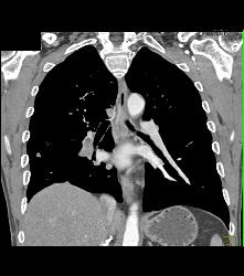Pulmonary Embolism (PE) and Lung Metastases - CTisus CT Scan