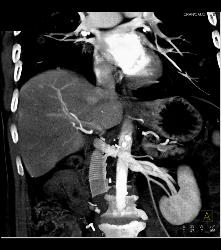 IVC Graft and PE - CTisus CT Scan