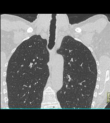 Incredible Case of Tracheopathia Osteochondroplastica- See Full Sequence - CTisus CT Scan