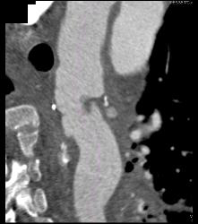 Leaking Aortic Aneurysm With Mediastinal Hematoma- See Full Sequence - CTisus CT Scan
