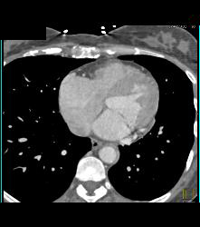 Cavitary Lesion Left Upper Lung- Cavitary Lesion Due to Tuberculosis (TB) - CTisus CT Scan