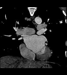 Cavitary Lesion Left Upper Lung- Cavitary Lesion Due to Tuberculosis (TB) - CTisus CT Scan