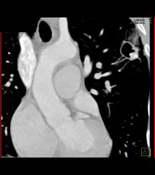 Cavitary Lesion Left Upper Lung- Cavitary Lesion Due to Tuberculosis (TB) - CTisus CT Scan