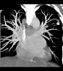 Cavitary Lesion Left Upper Lung- Cavitary Lesion Due to Tuberculosis (TB) - CTisus CT Scan