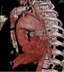 Dilated Arch With Stents in SVC and Pulmonary Arteries - CTisus CT Scan