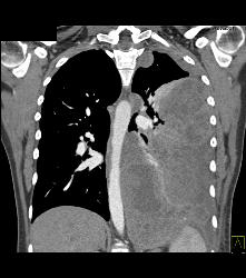 Ewing Sarcoma in Left Chest - CTisus CT Scan
