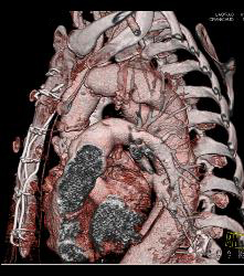 Repaired Ascending Aorta With Reimplanted Coronary Artery. Note Dissection Still in Descending Thoracic Aorta - CTisus CT Scan