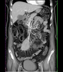 Lymphoma in Pleura and Ribs and Mesentery - CTisus CT Scan