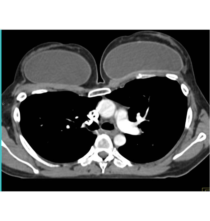 Lung Metastases from Breast Cancer - CTisus CT Scan