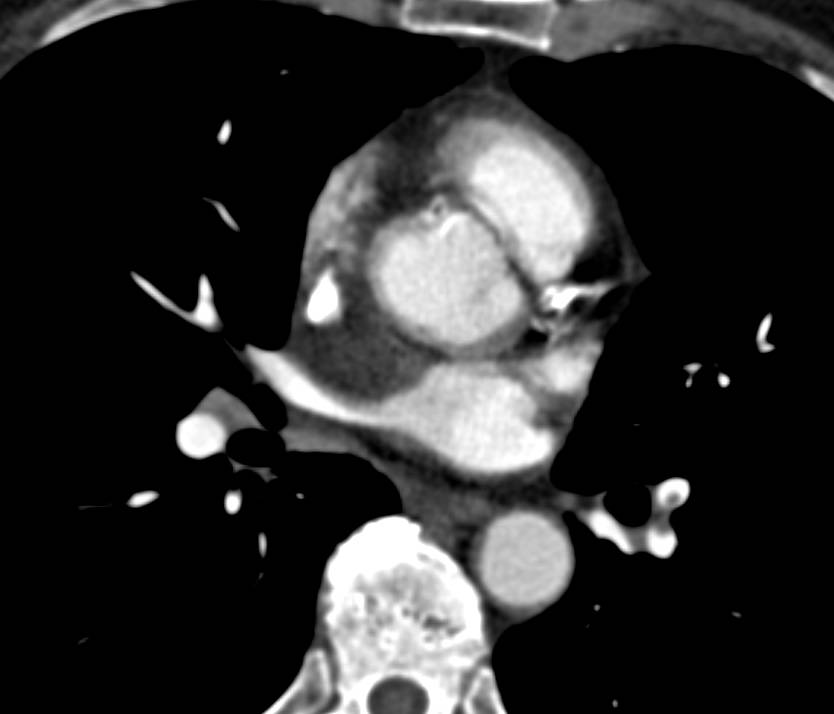 Pulmonary Embolism Left Lower Lung Pulmonary Artery - CTisus CT Scan