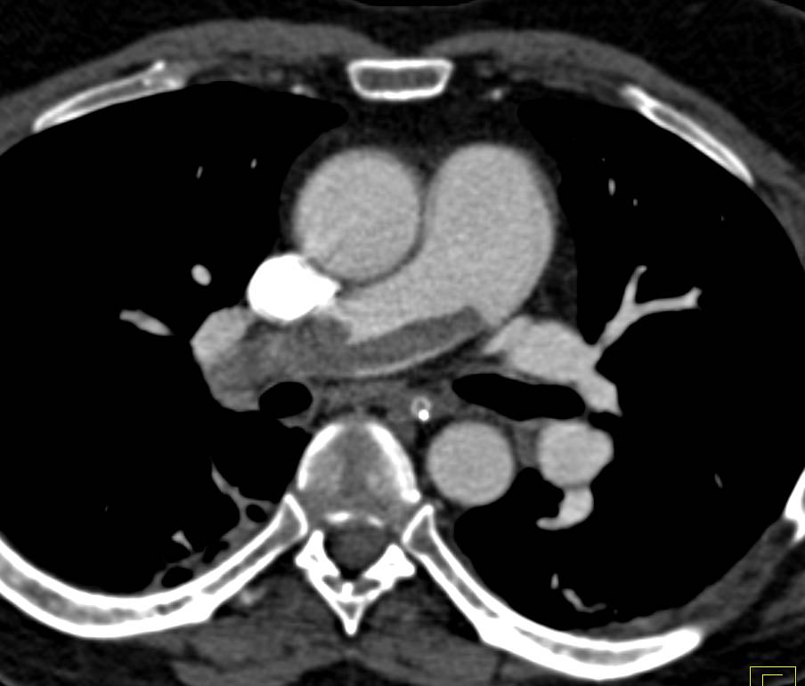Saddle Pulmonary Embolism - CTisus CT Scan