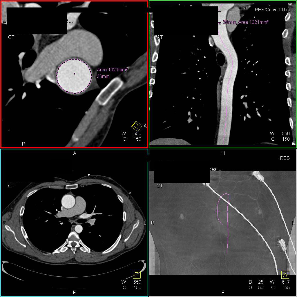 Vascular Mapping of the Thoracic Aorta - CTisus CT Scan