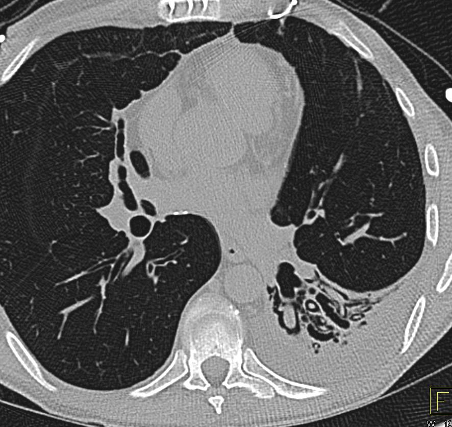 Bronchiectasis with Mucus Plugging Left Lower Lung - CTisus CT Scan
