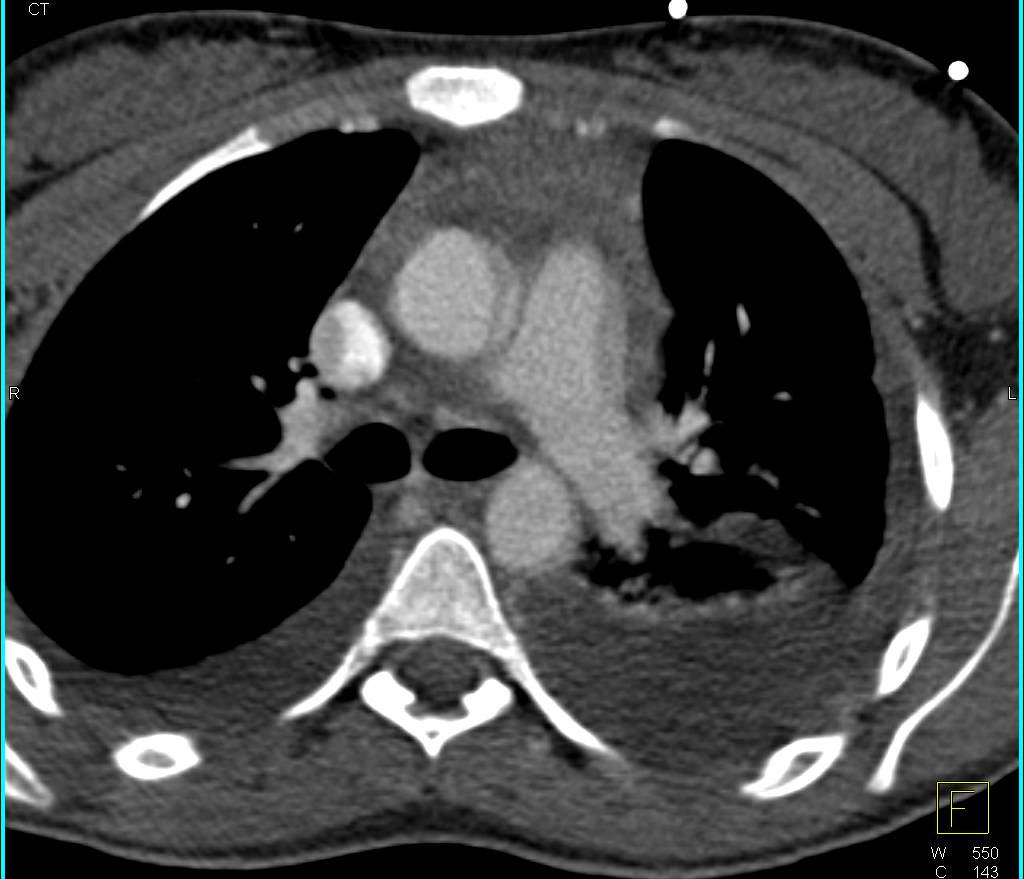 Hemopericardium with 