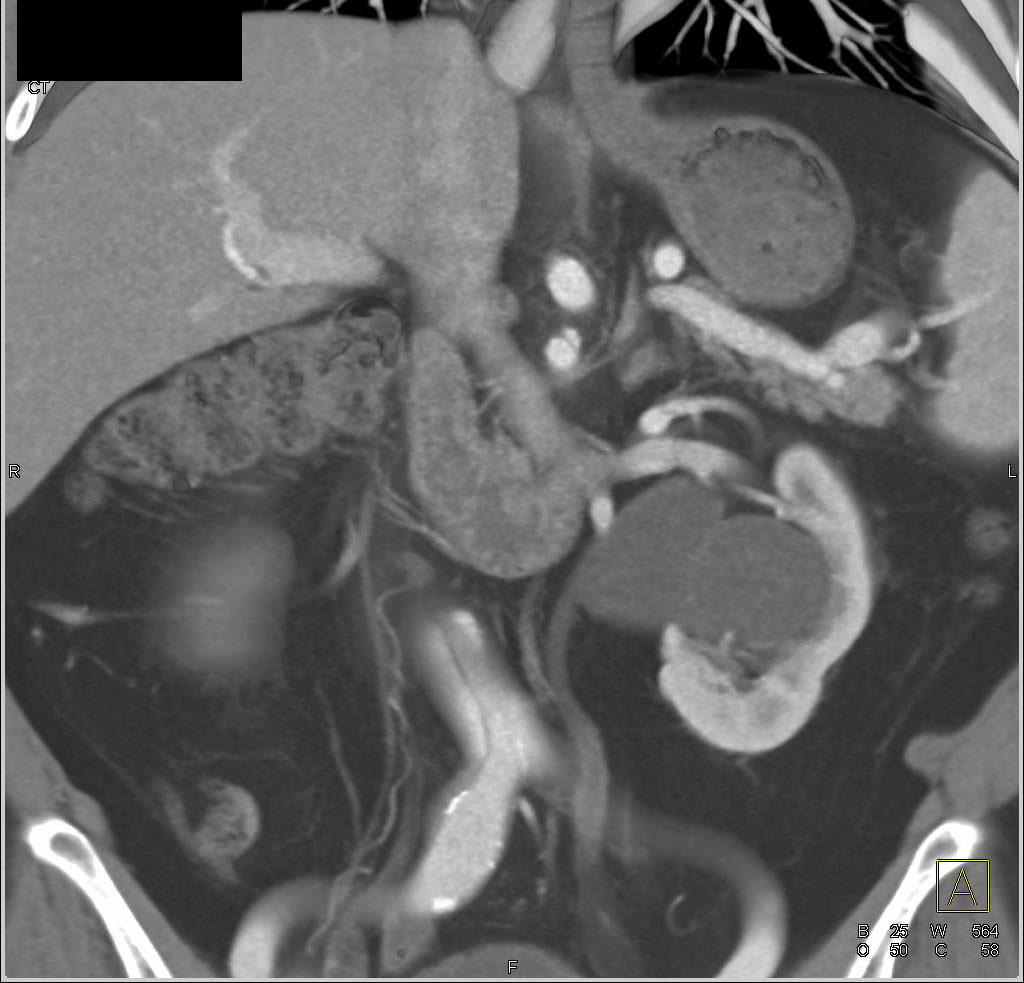 Type A Dissection with Repair and Dissection Present in Descending Thoracic Aorta as well as Abdominal Aorta - CTisus CT Scan