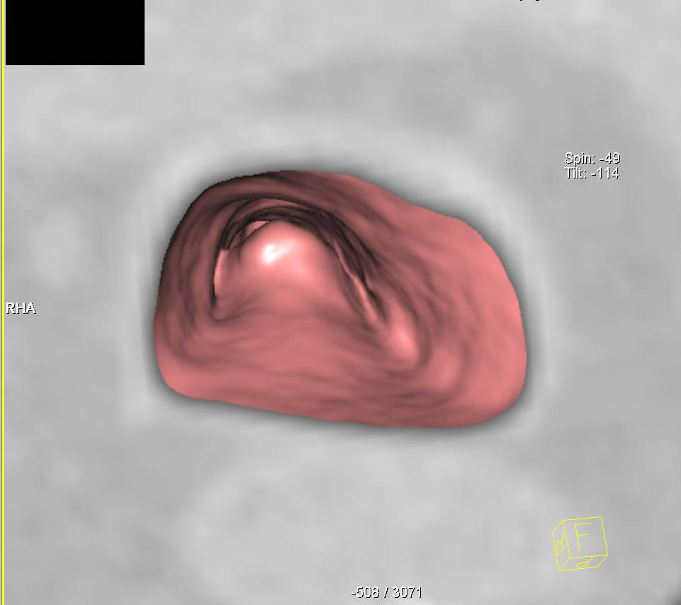 Adenoid Cystic Carcinoma of the Trachea with 3D Display - CTisus CT Scan