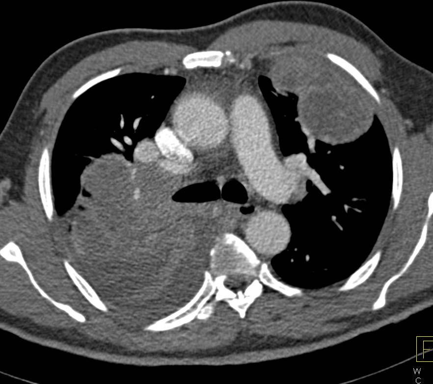 Lung Cancer with Direct Extension into the Left Atrium via the Pulmonary Veins - CTisus CT Scan
