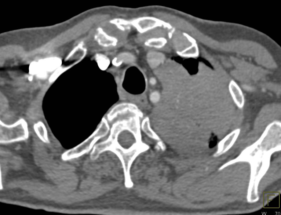 Lung Cancer Encases the Left Hilum - CTisus CT Scan