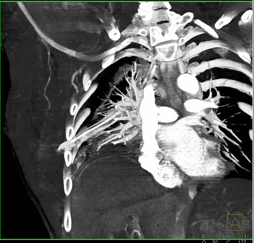 Trauma with Chest Wall Bleed and Pulmonary Hemorrhage Following Chest Tube Insertion - CTisus CT Scan