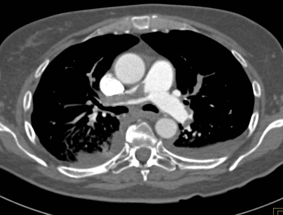 Extensive Pulmonary Embolism - CTisus CT Scan