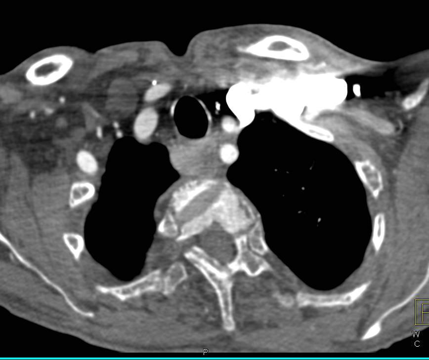 Residual Thyroid Tissue in Posterior Mediastinum - CTisus CT Scan