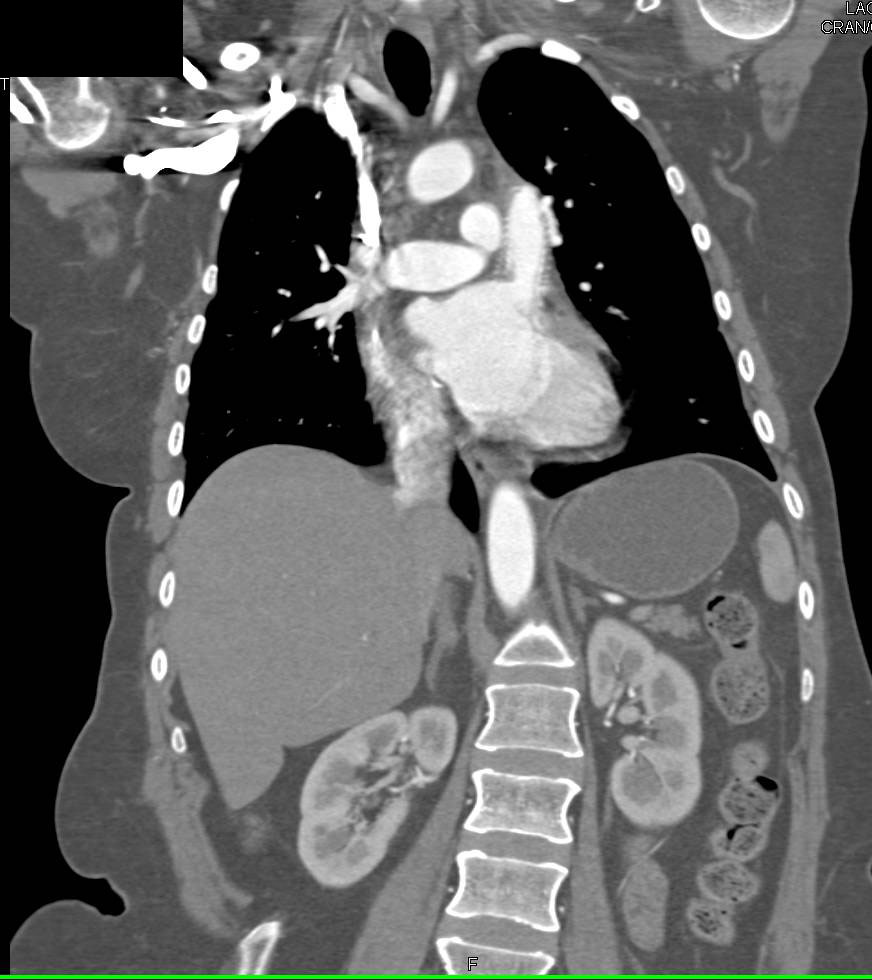 Patent Stent from Pulmonary Artery to Left Atrium - CTisus CT Scan