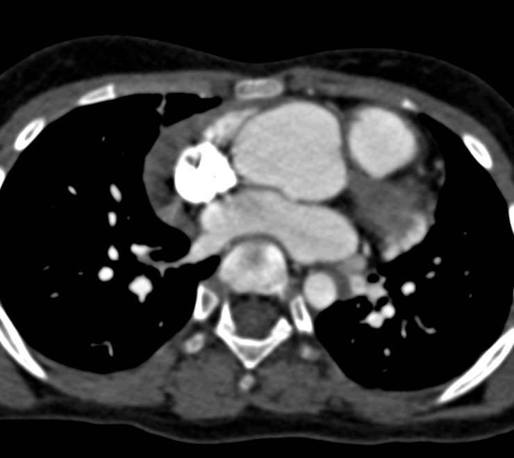 Loeys-Dietz Syndrome with Dilated Ascending Aorta and Ectatic Carotid Arteries - CTisus CT Scan